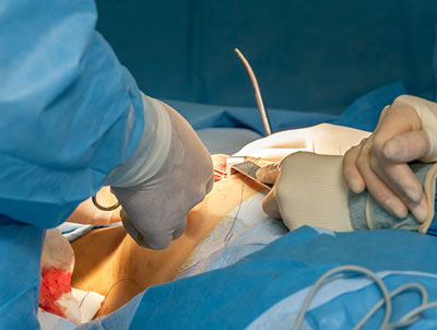 Breast Reconstruction